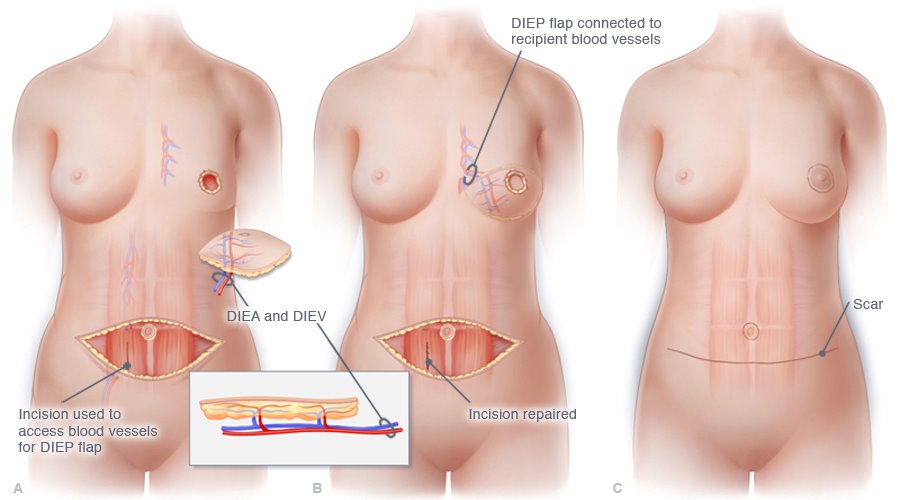 Tummy Tuck in Biloxi, MS