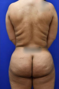 Brazilian Butt Lift Before and After Pictures Biloxi, MS