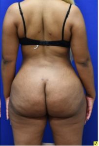 Brazilian Butt Lift Before and After Pictures Biloxi, MS