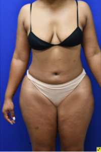 Brazilian Butt Lift Before and After Pictures Biloxi, MS