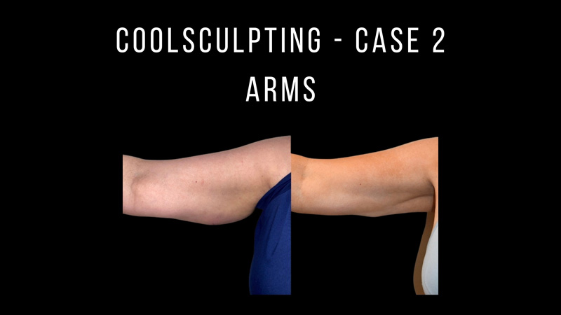 CoolSculpting Pictures in Biloxi, MS