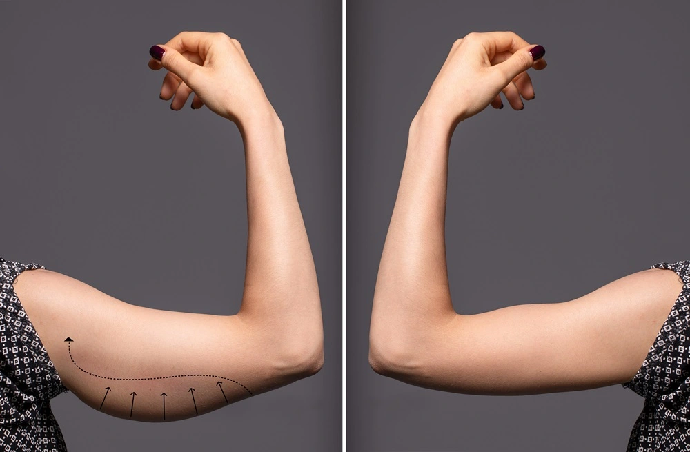 armlift-michael-diaz-md