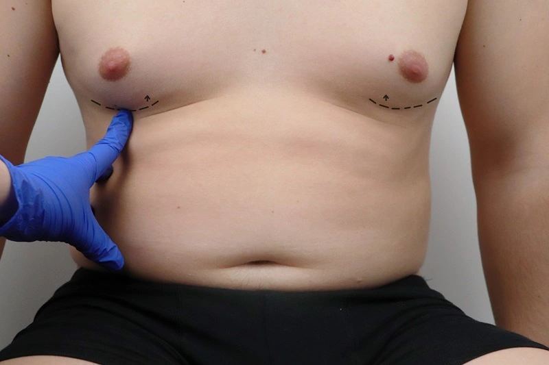 gynecomastia-michael-diaz-md