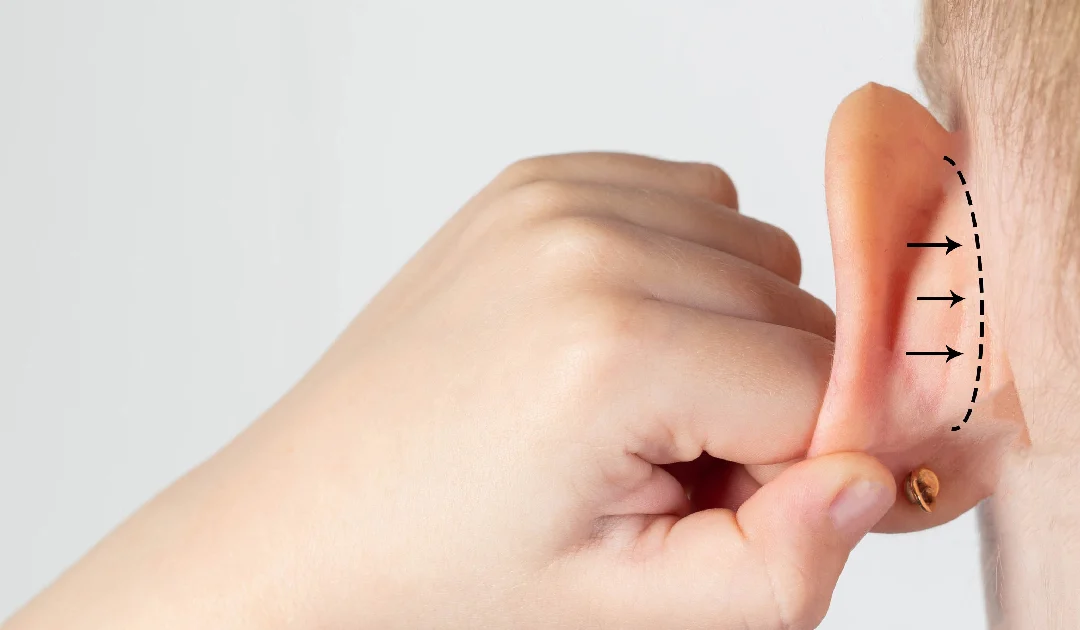 Child holding ear with surgical marks, showing preparation for doing Otoplasty in Biloxi, MS to correct prominent ears.