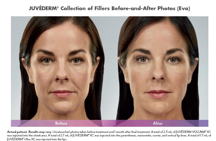 Juvederm Before and After Pictures Biloxi, MS