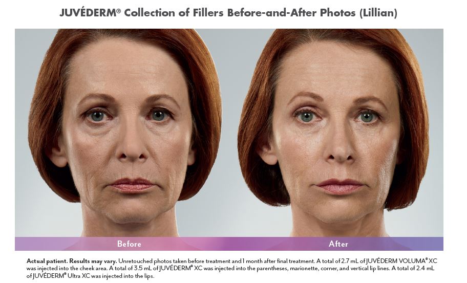 Michael Diaz MD, Biloxi MS, Juvederm Before and After