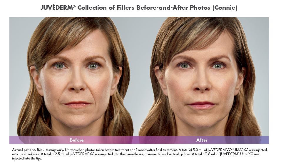 Juvederm Before and After, Biloxi MS, Michael Diaz MD