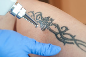 Laser Tattoo Removal in Biloxi, MS