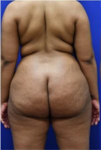 Brazilian Butt Lift Before and After Pictures Biloxi, MS