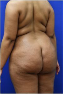 Brazilian Butt Lift Before and After Pictures Biloxi, MS