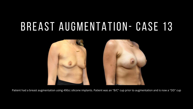 Breast Augmentation Pictures in Biloxi, MS