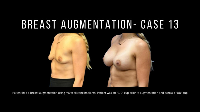 Breast Augmentation Pictures in Biloxi, MS