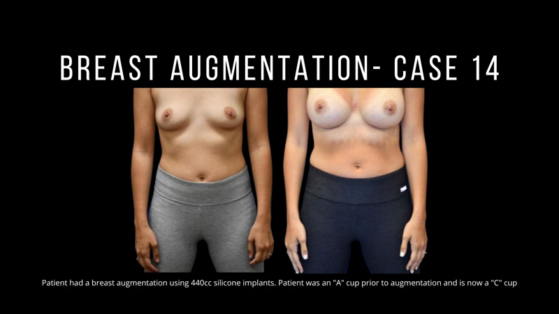 Breast Augmentation Pictures in Biloxi, MS