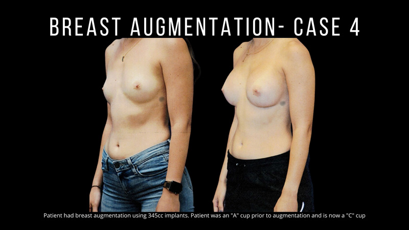 Breast Augmentation Pictures in Biloxi, MS