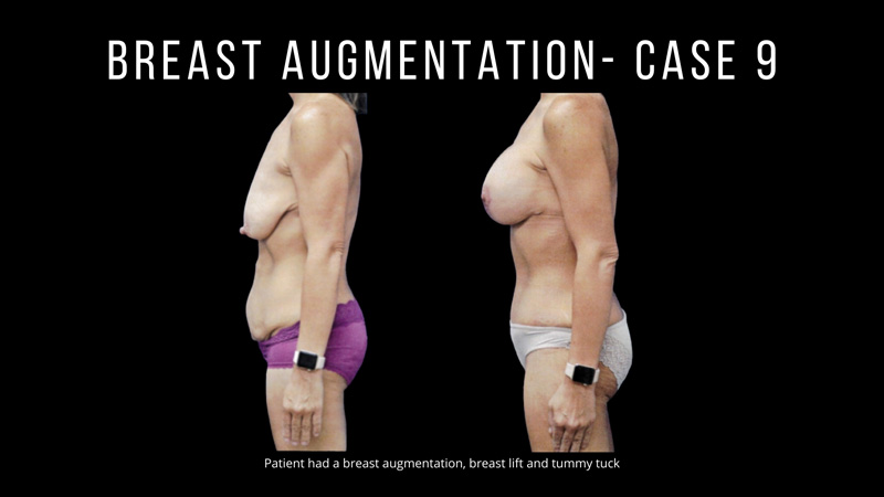 Breast Augmentation Pictures in Biloxi, MS