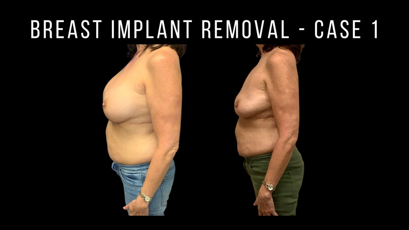 Breast Implants Pictures in Biloxi, MS