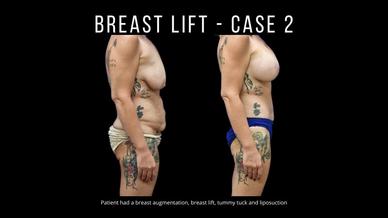 Breast Lift Pictures in Biloxi, MS