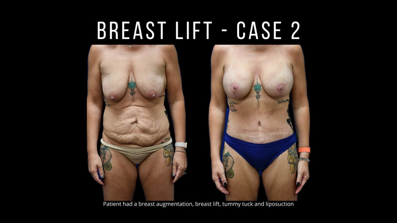 Breast Lift Pictures in Biloxi, MS