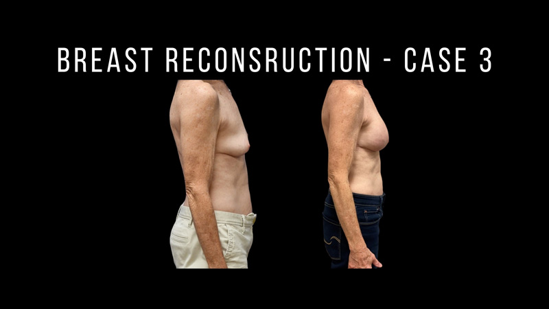 Breast Reconstruction Pictures in Biloxi, MS