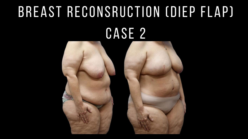 Breast Reconstruction Pictures in Biloxi, MS