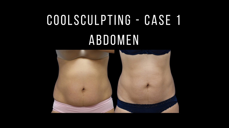 CoolSculpting Pictures in Biloxi, MS