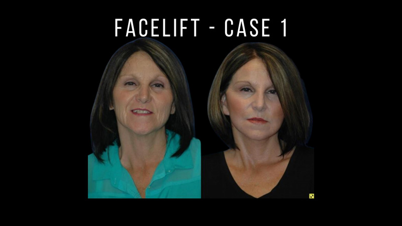 Facelift Pictures in Biloxi, MS