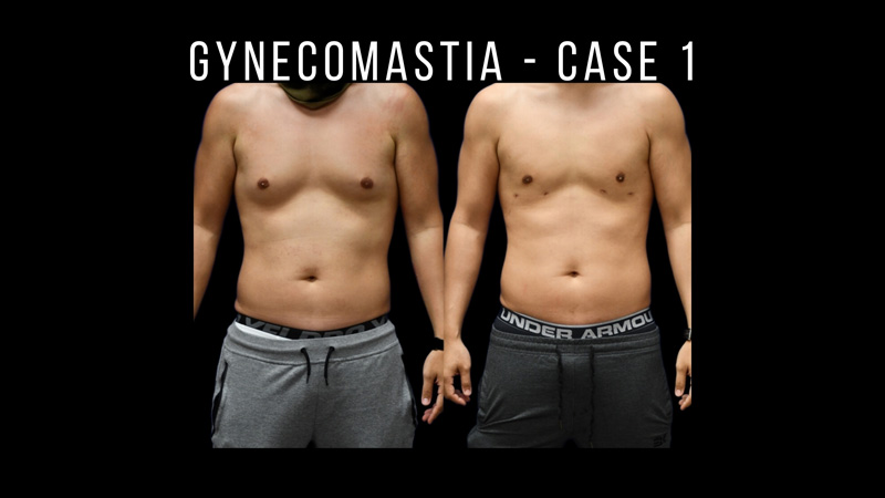 Gynecomastia Pictures in Biloxi, MS