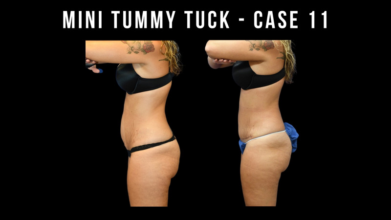 Mini Tummy Tuck Pictures in Biloxi, MS
