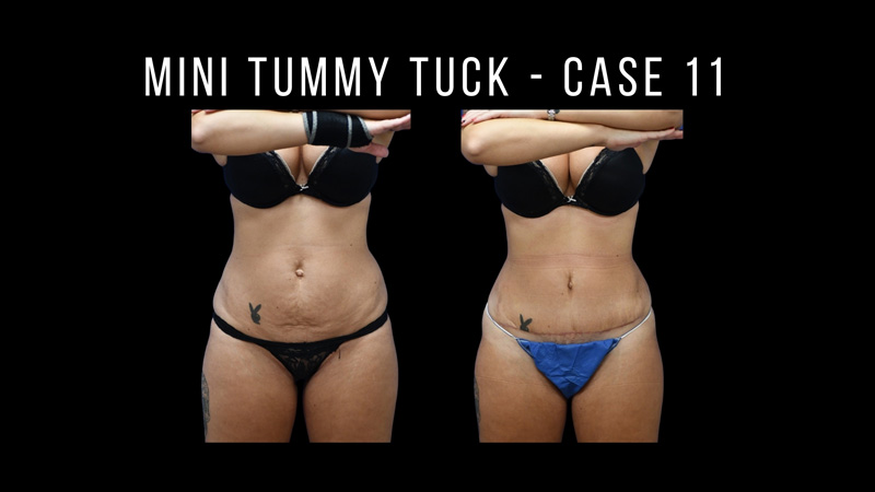 Mini Tummy Tuck Pictures in Biloxi, MS