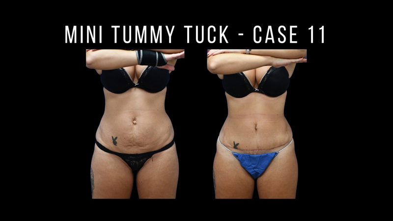 Mini Tummy Tuck Before & After Photos Fort Lauderdale, Coral Springs