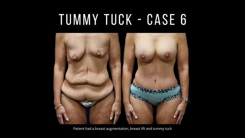 Best Tummy Tuck Case #231