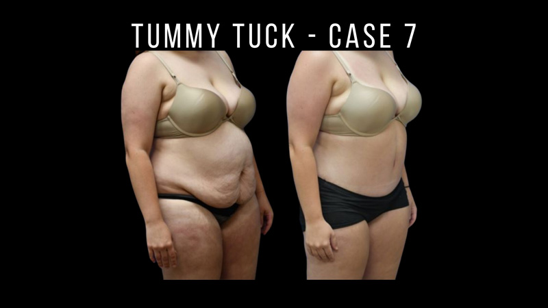 Tummy Tuck Pictures in Biloxi, MS
