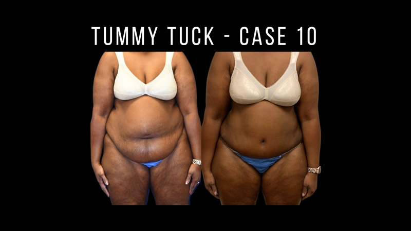Tummy Tuck Pictures in Biloxi, MS